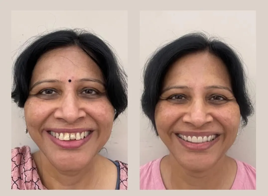 Complete smile makeover before and after — veneers and crowns by Dr. Karuna Singh Sawhny at My Dentist Kanpur