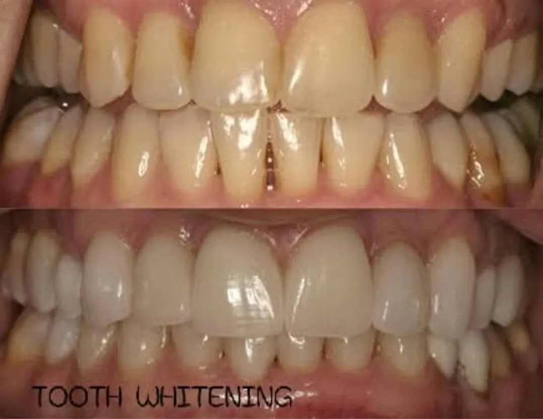 Teeth whitening before and after result — brighter smile at My Dentist Kakadeo Kanpur