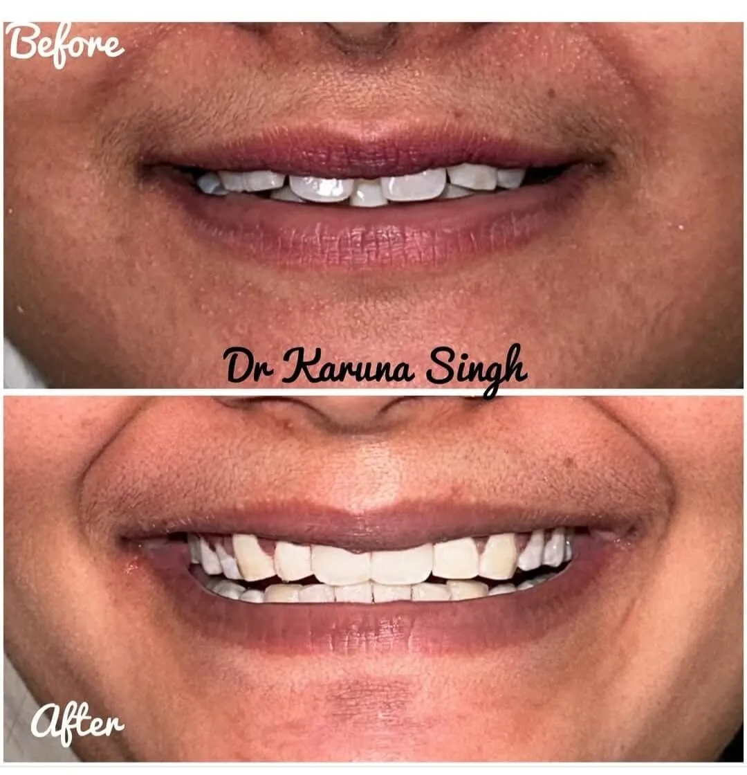 Professional teeth whitening before and after — My Dentist Kakadeo Kanpur