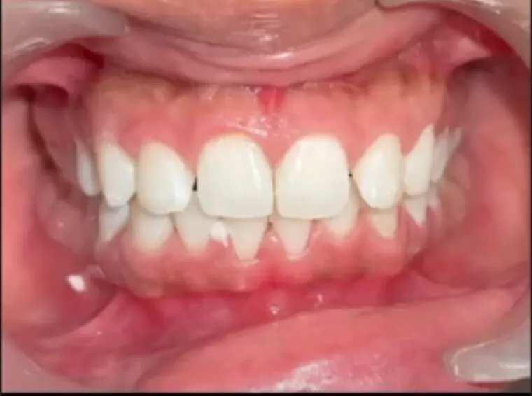 Gum treatment before and after — bleeding inflamed gums treated at My Dentist Kakadeo Kanpur