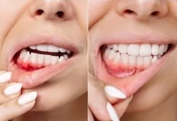 Periodontics before and after — healthy gums restored after scaling and root planing at My Dentist Kanpur