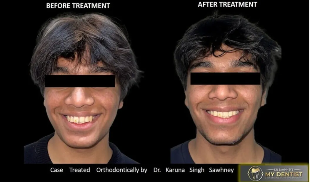 Dental implant before and after — missing teeth replaced with titanium implants at My Dentist Naveen Nagar Kanpur