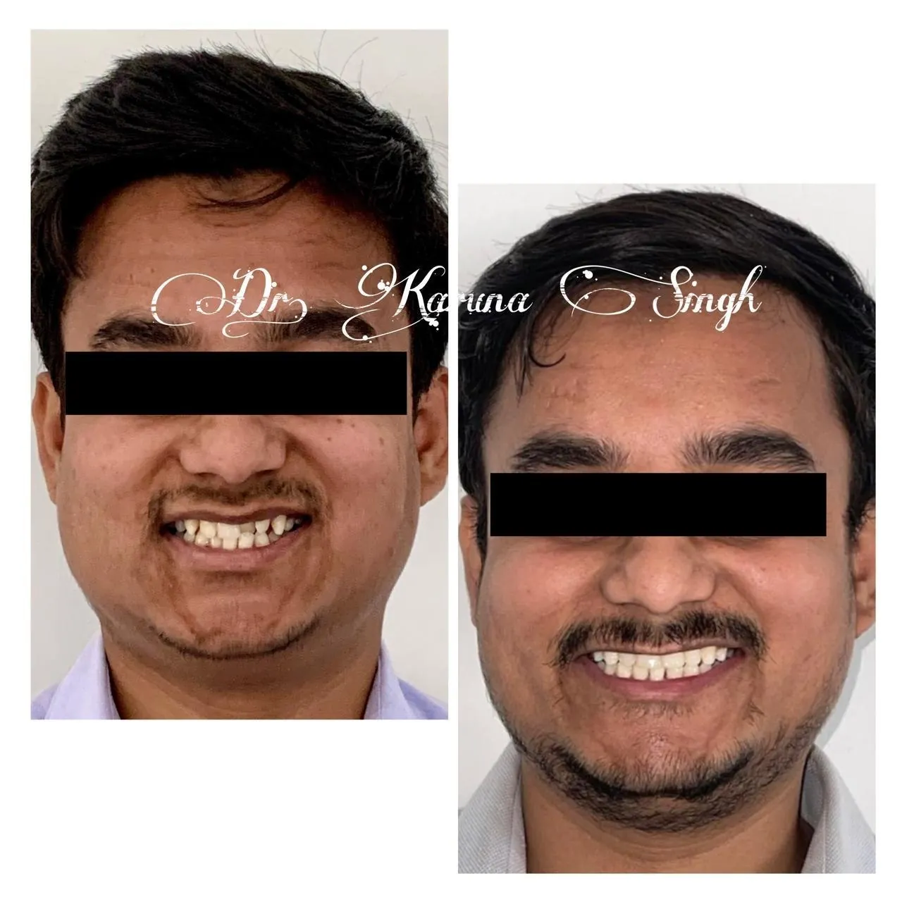 Orthodontics — Adult Braces — before & after, Case treated by Dr. Karuna Singh Sawhny
