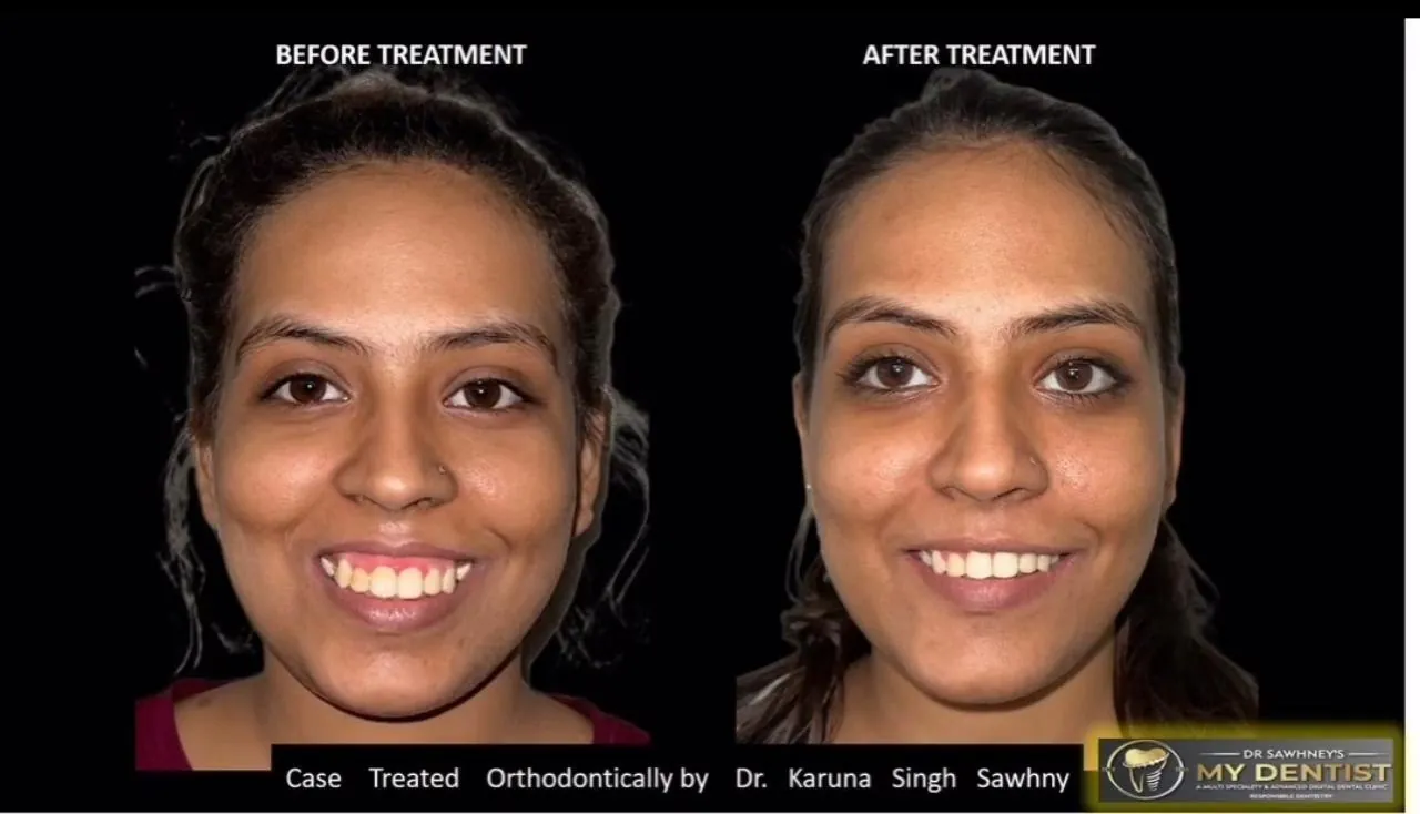 Orthodontics — Full Face — before & after, Case treated by Dr. Karuna Singh Sawhny