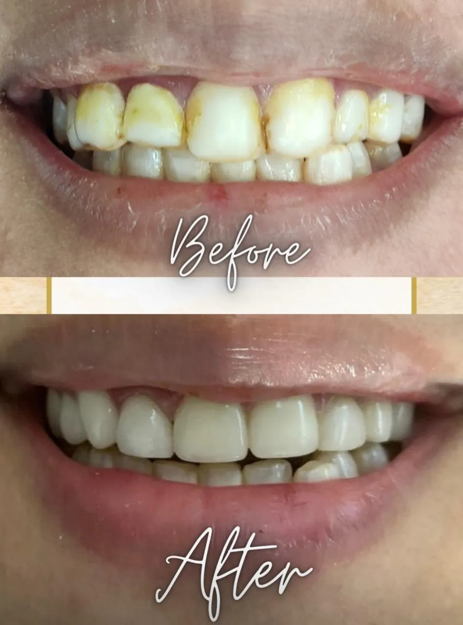 Smile Makeover — Veneers — before & after