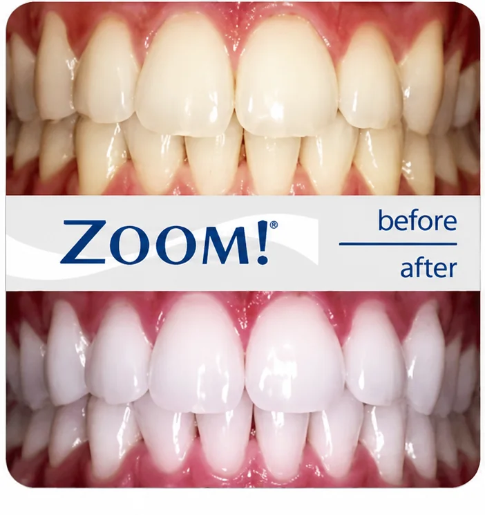 ZOOM! Teeth Whitening — before & after