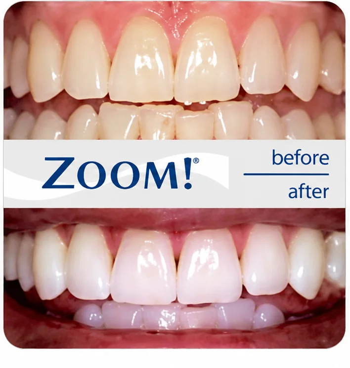 ZOOM! Teeth Whitening — before & after