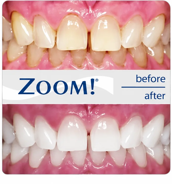 ZOOM! Teeth Whitening — before & after