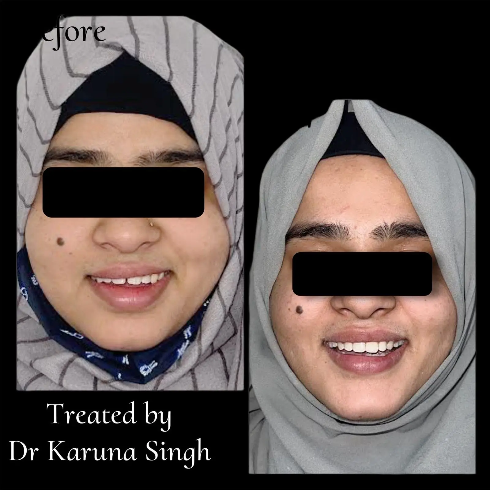 Before and after braces treatment — severely crowded teeth corrected by Dr. Karuna Singh Sawhny, Orthodontist, My Dentist Kanpur