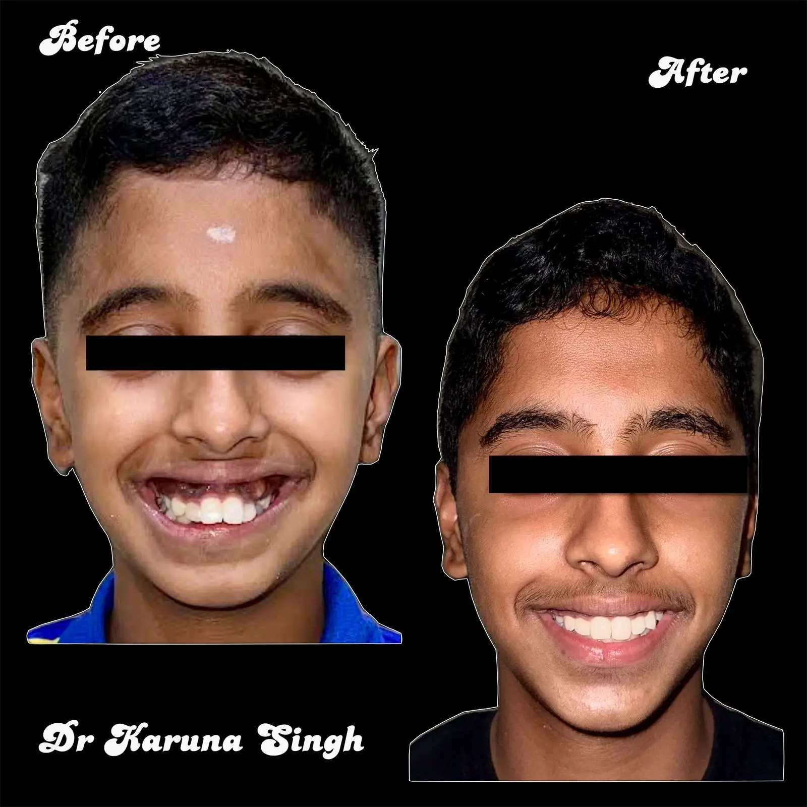 Orthodontic before and after — crooked teeth aligned with braces by Dr. Karuna Singh Sawhny at My Dentist Kakadeo