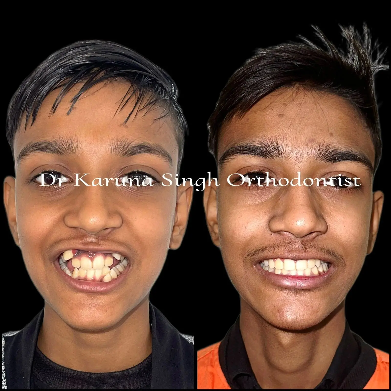 Before and after smile transformation — braces treatment result by Dr. Karuna Singh Sawhny, My Dentist Kanpur