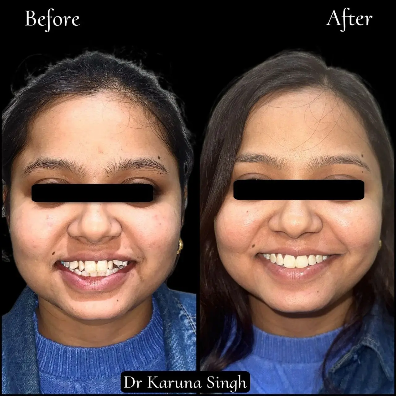 Orthodontic case before and after — teeth alignment result by Dr. Karuna Singh Sawhny at My Dentist Kakadeo Kanpur
