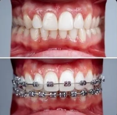 Metal braces close-up — orthodontic treatment with ceramic and metal brackets at My Dentist Kanpur