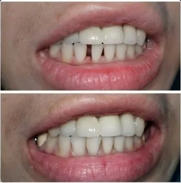 Prosthodontic smile restoration before and after — crowns and bridges at My Dentist Kakadeo Kanpur