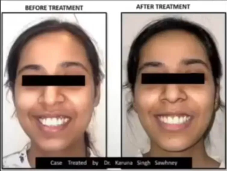 Root canal treatment before and after — pain-free RCT at My Dentist Kakadeo Kanpur