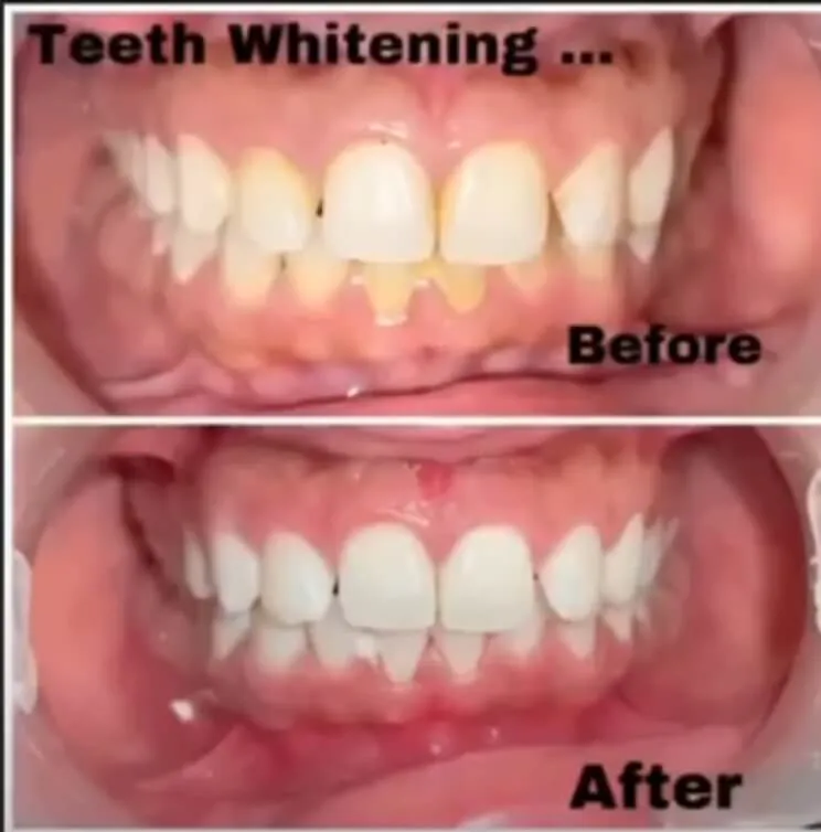 Smile close-up before and after cosmetic treatment — My Dentist Kakadeo Kanpur