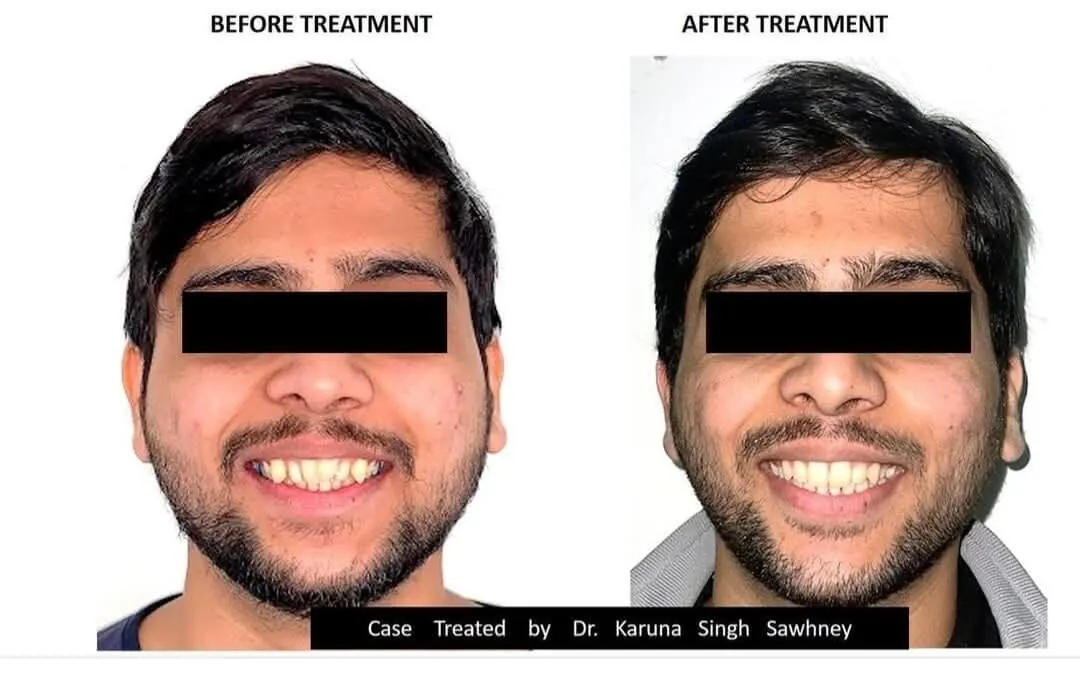 Restorative dentistry before and after — missing tooth replaced with bridge at My Dentist Kanpur