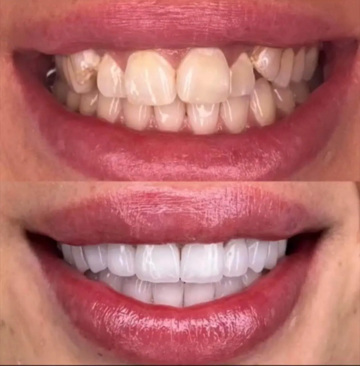 Teeth whitening before and after — professional in-office whitening result at My Dentist Kanpur
