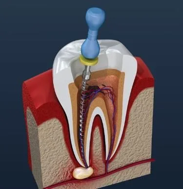Single Sitting Root Canal Treatment