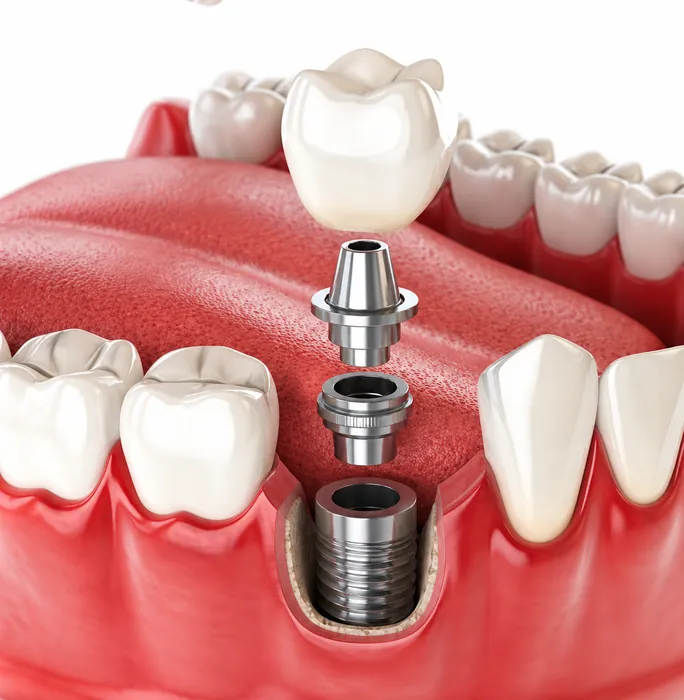 Dental implant candidacy assessment at MY DENTIST Kakadeo