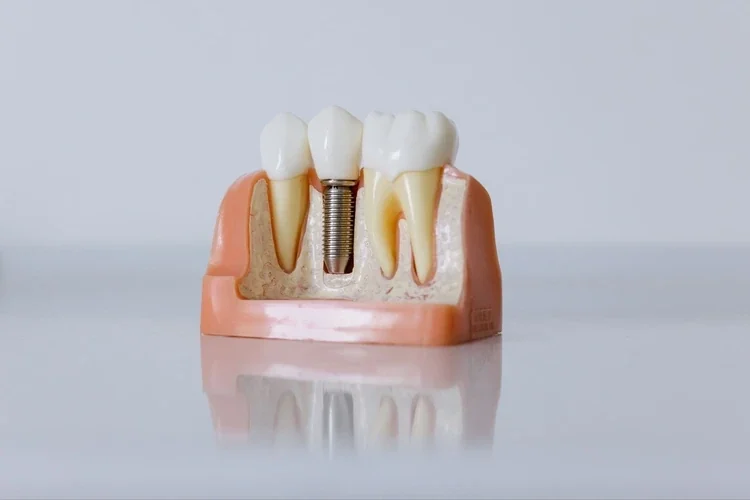 Dental implant procedure close-up