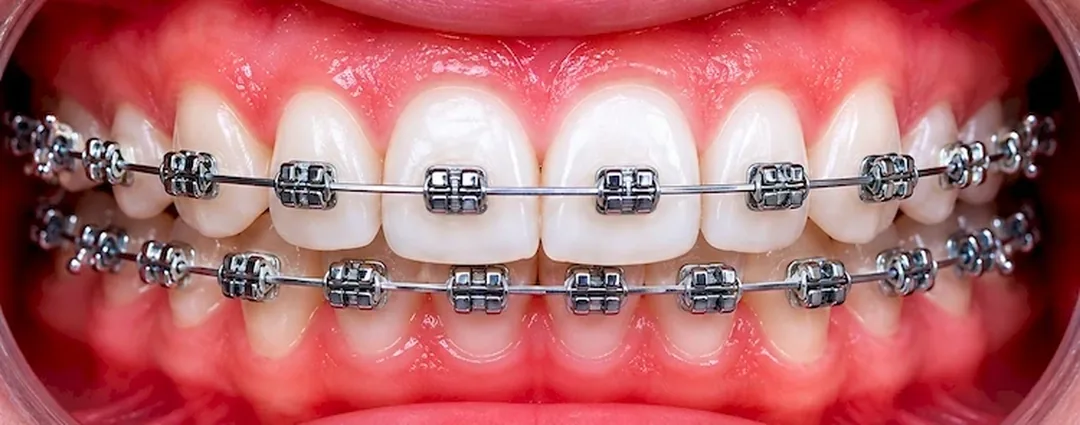 Orthodontic treatment before and after results at MY DENTIST Kanpur