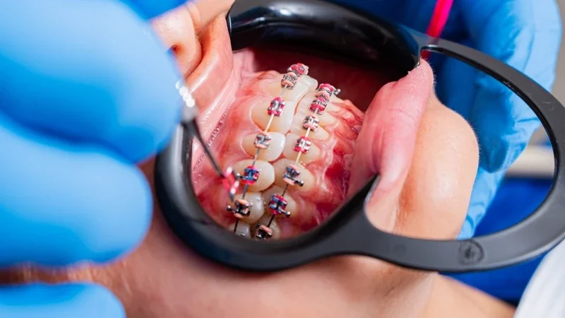 Orthodontic treatment at MY DENTIST Kanpur