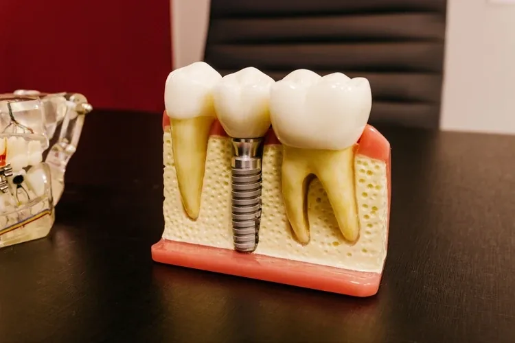 Prosthodontic crown and bridge treatment at MY DENTIST Kanpur