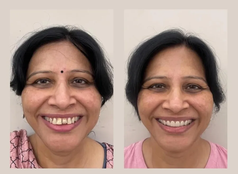 Smile makeover before and after results at MY DENTIST Kanpur