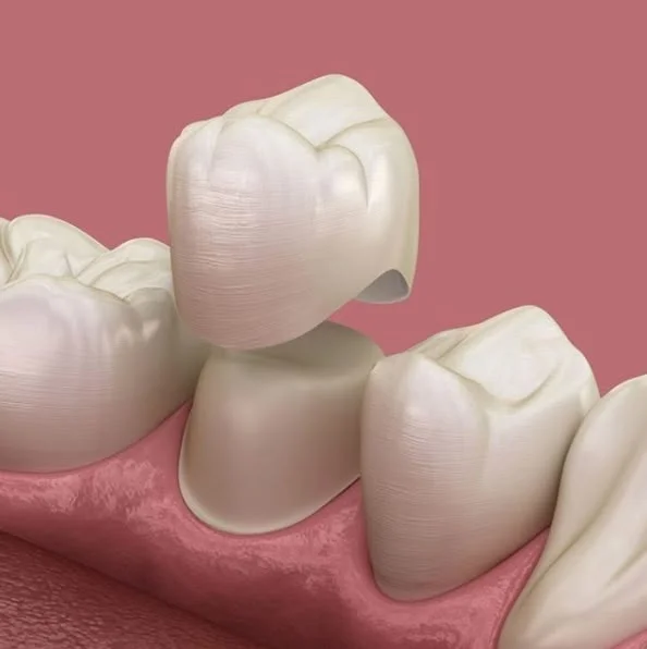 Diagram of a dental crown fitting over a prepared tooth, similar to a CEREC crown restoration
